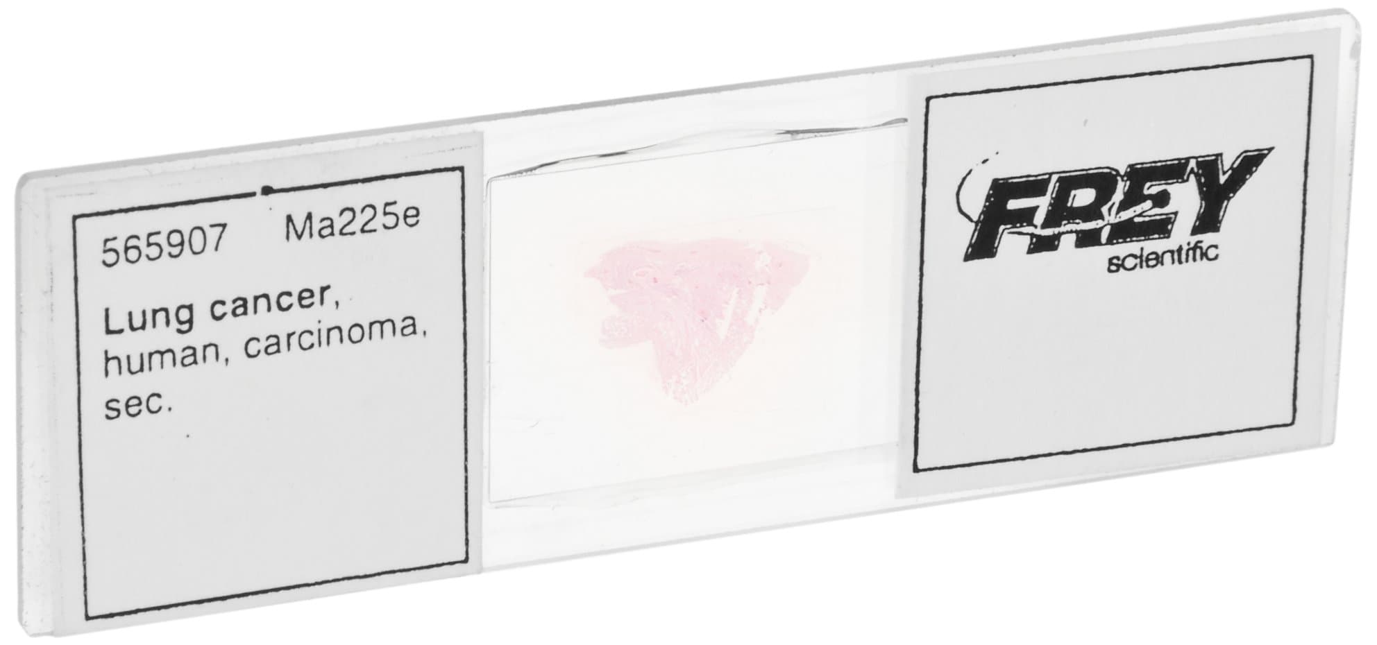 Frey Scientific Lieder Prepared Human Lung Cancer Microscope Slide, 3" Length x 1" Width