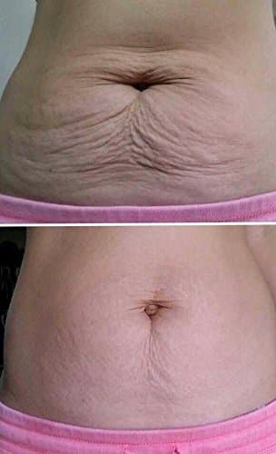 Cellulite Reduction - NeriumFirm